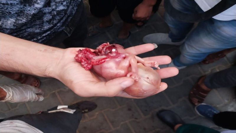بالصورة: الاحتلال يقتل جنيناً في بطن أمه قبل الخروج للحياة في المجزرة التي ارتكبها  قبل قليل بغزة