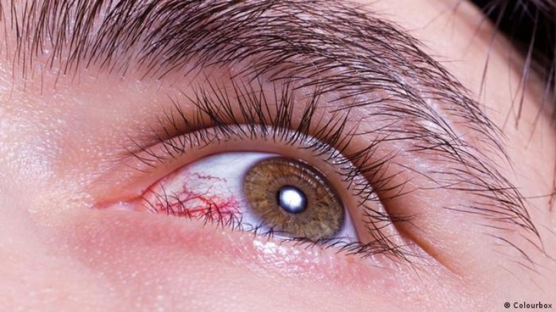 هل من ارتباط بين صحة العين والخرف؟