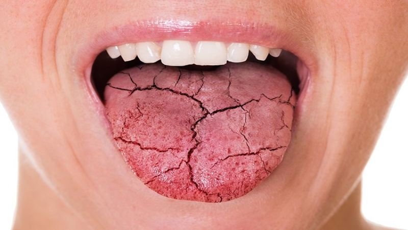 جفاف الفم قد يشي بأمراض خطيرة