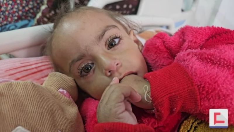 سوء التغذية يُهدّد مئات الأطفال بالموت في غزة